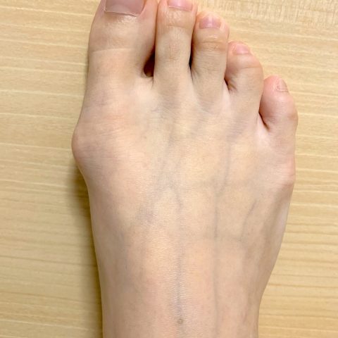 歩くと足の親指が痛い！！つらい外反母趾の原因と治療法！